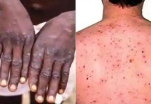 মাঙ্কিপক্স ছড়িয়েছে বিশ্বের ৭৫ দেশে